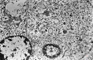 M, 62y. | angiomatous tumor, v.s. Kaposi sarcoma M, 62y. | angiomatous tumor, v.s. Kaposi sarcoma